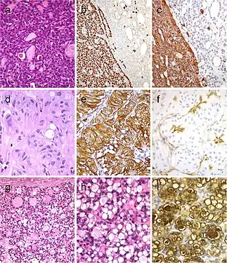 Tumor of the thyroid with solid cell nest features disclosing small cells of the main cell type (a) that express p63 (b) and cytokeratin 5 (c), in the absence of TTF1, calcitonin, and thyroglobulin expression. Hyalinizing trabecular tumor (d–f) is composed of trabeculae of elongated or polygonal cells admixed with abundant amounts of hyaline material negative for amyloid and positive for type IV collagen (f); Ki-67 is characteristically expressed in the cell membrane but not in the nuclei of the tumor cells (e). Follicular adenoma with signet ring cells (g and h), showing strong positivity for thyroglobulin (i)