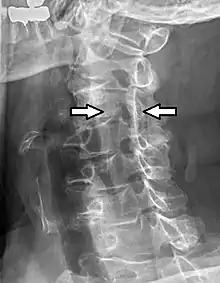 Projectional radiograph of a man presenting with pain by the nape and left shoulder, showing a stenosis in the intervertebral foramen of cervical spinal nerve 4, corresponding with the affected dermatome.